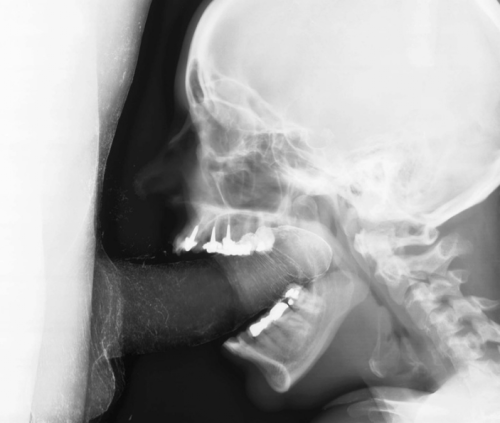 X ray deepthroat Super deepthroat